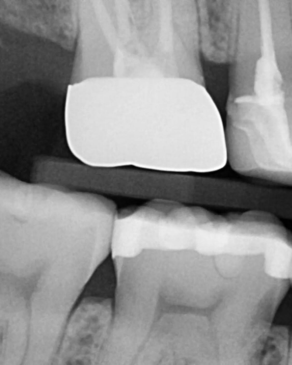 Dental radiograph used for general dentistry and restorations at mySmile Tirana